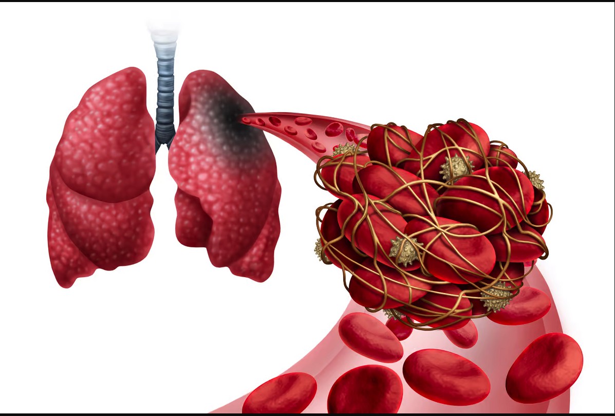 Step by step: how to diagnose pulmonary embolism